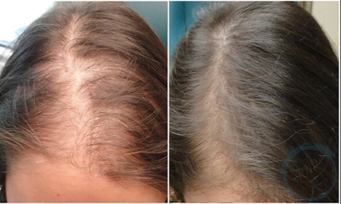 PRP/PRF RNR Hair Restoration