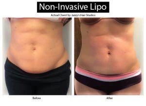 Non-Invasive Lipo