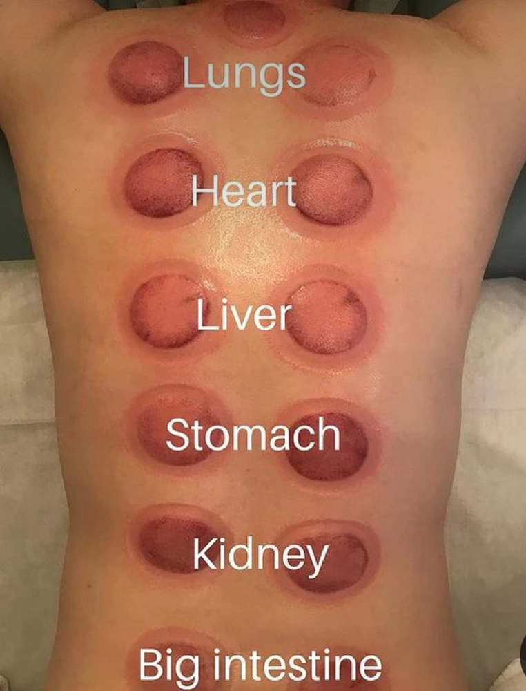 Focus Cupping Massage