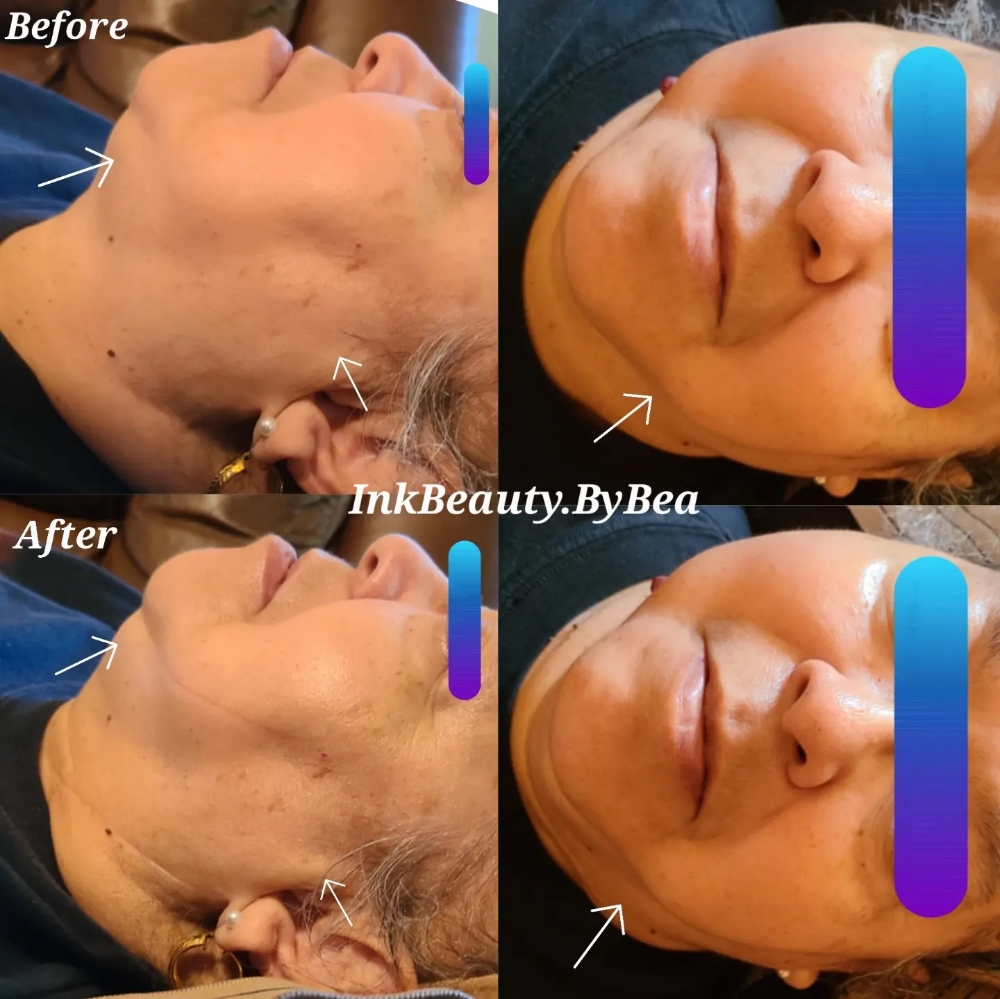 RF Facial Tightening &Lift 1se