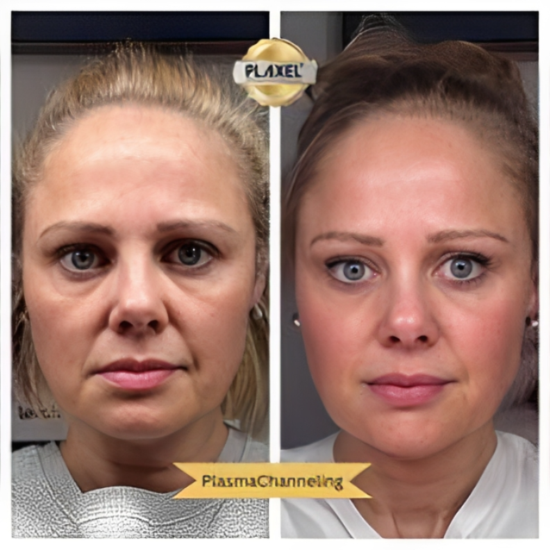 Triple Plasma Facial