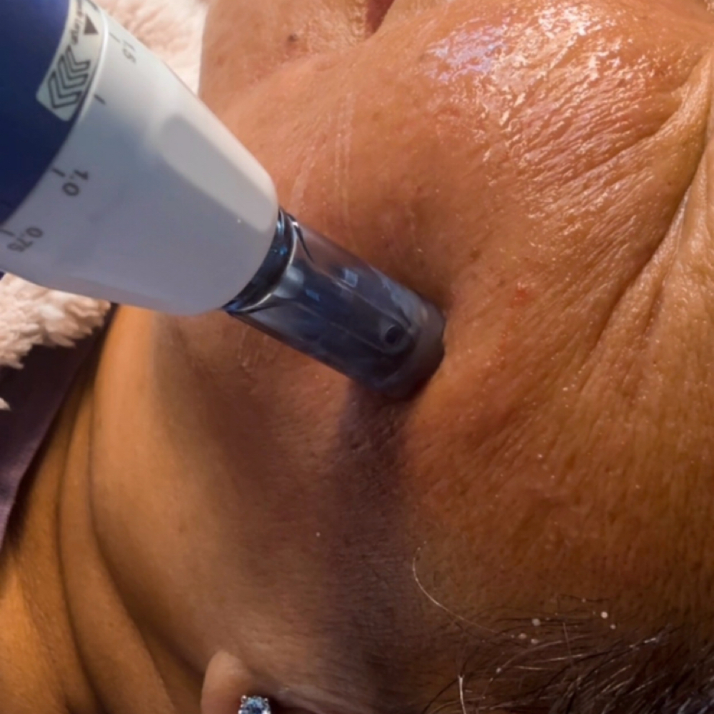 Microneedling(Dermapen) at Any Beauty Aesthetics Care in New York, NY