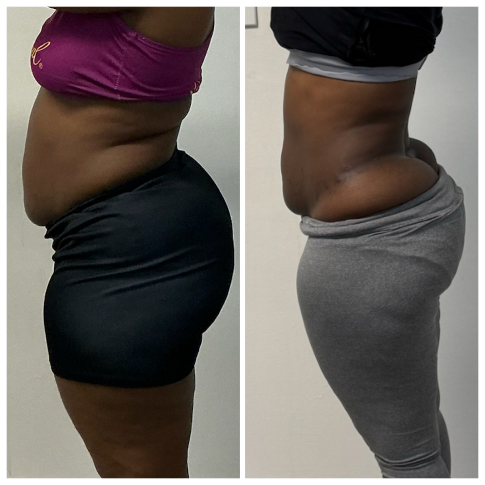 8 Cavitation & Laser Lipo 8 Ses.