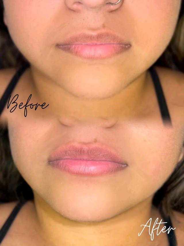Lip Plumping