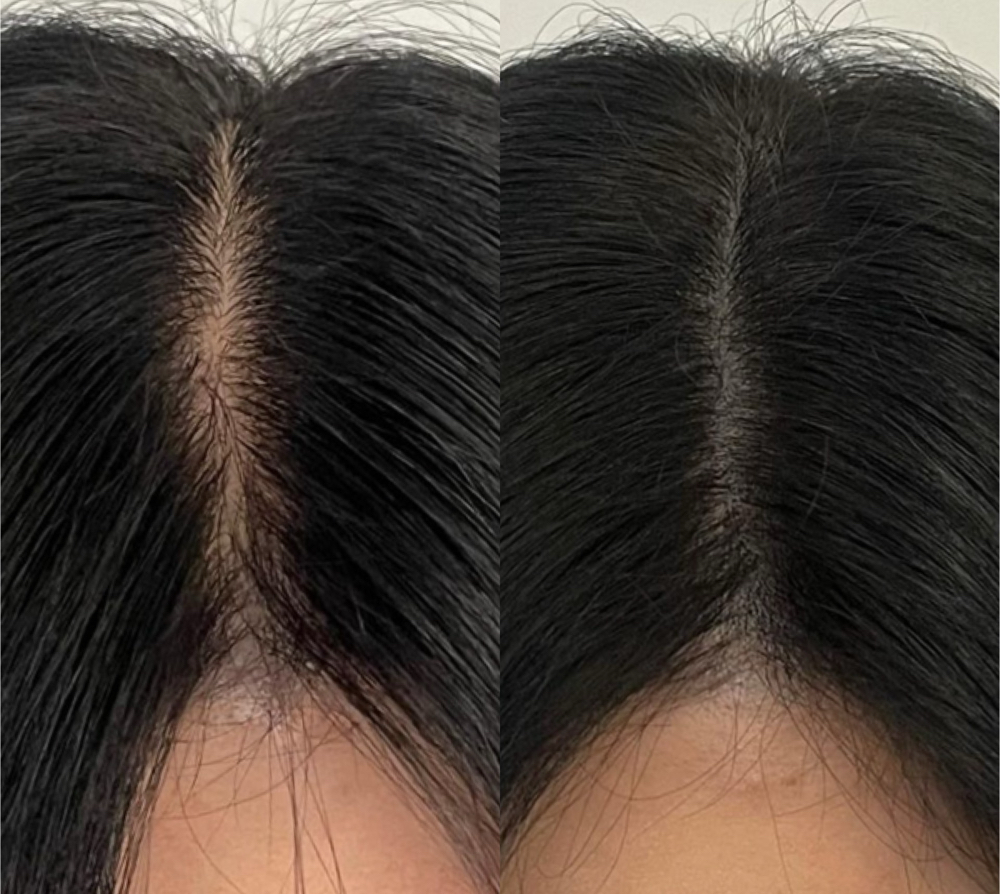 WOMENS SCALP MICRO PIGMENTATION (SM
