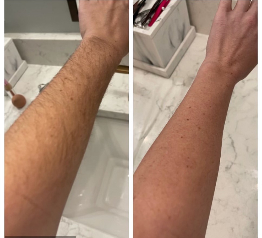 Laser Hair Removal (Half Arms)