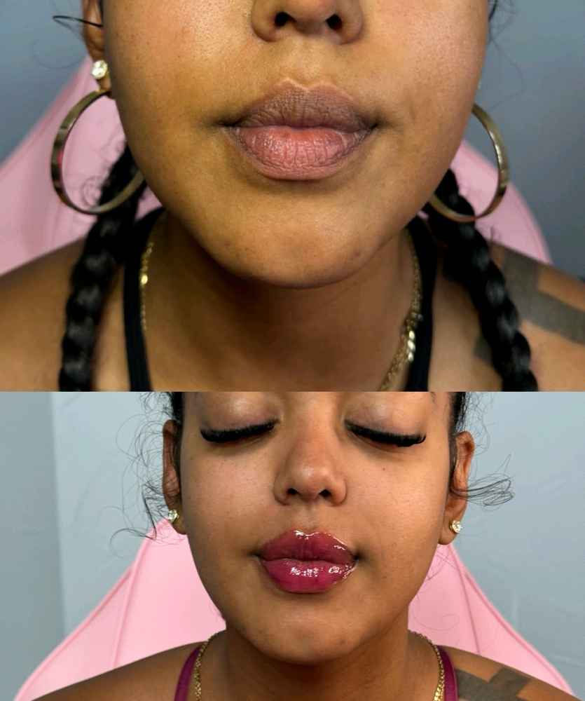 Full Lip Augmentation with Revision at ˈFæntəsi Lips 👄 in Lewisville, TX