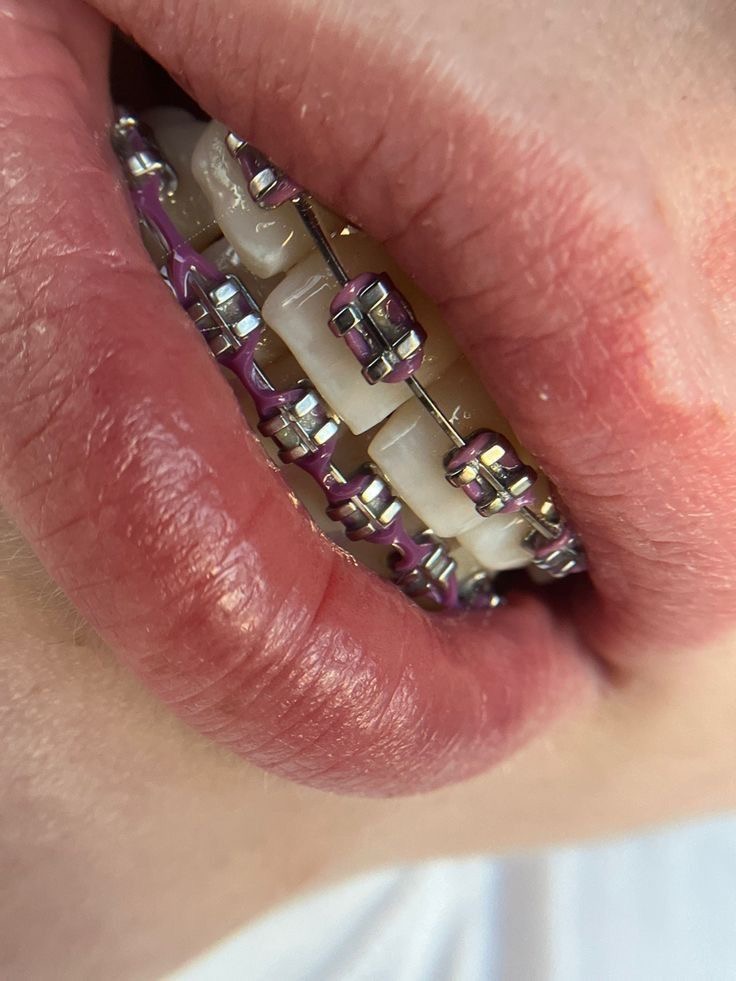 Braces Removal