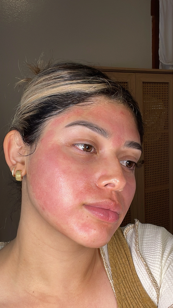 Exceed Microneedling