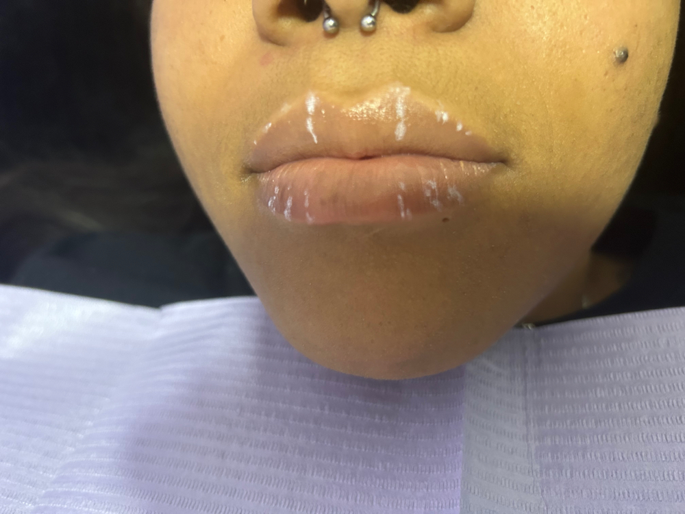 Lip Filler Consultation