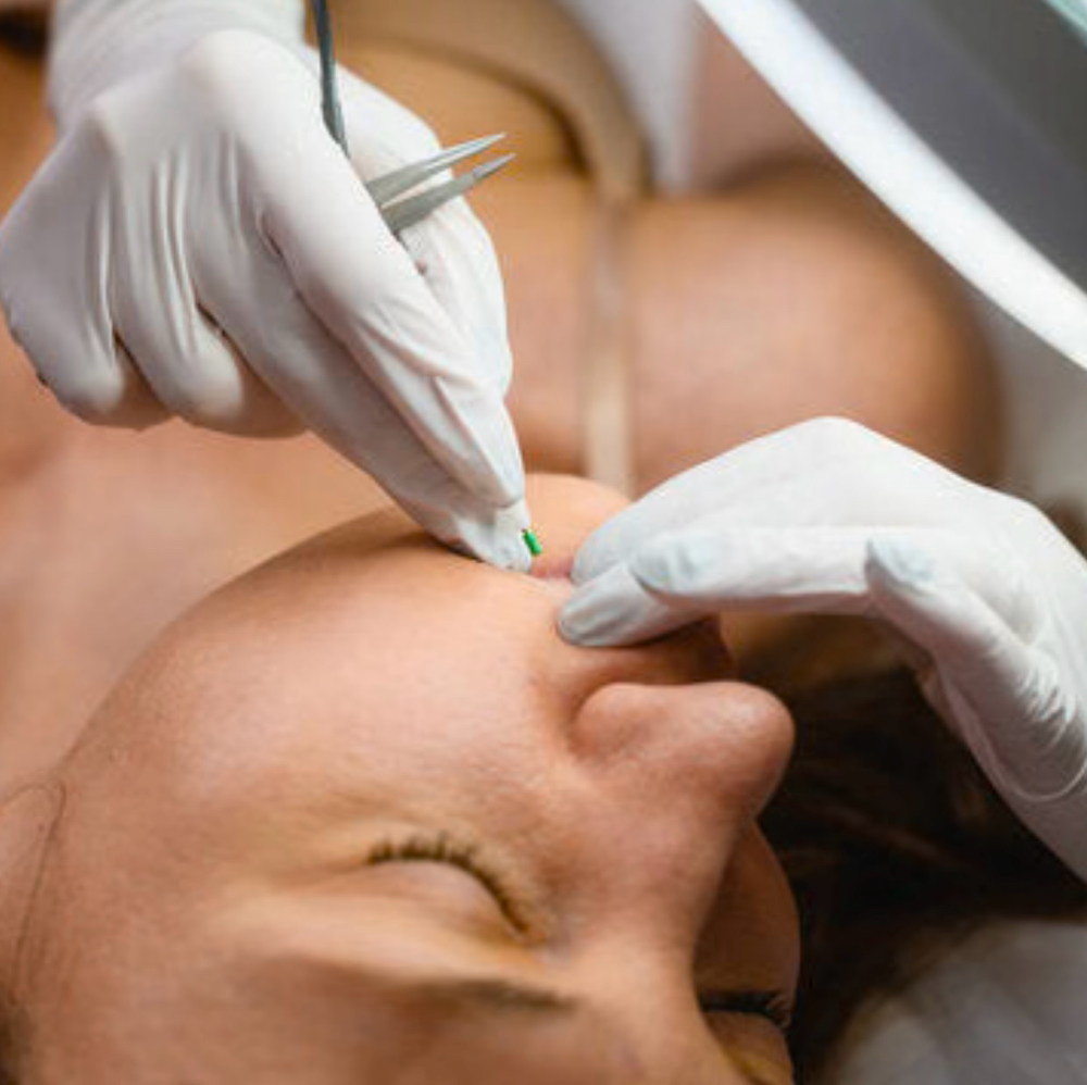Electrolysis 45 Minutes Session
