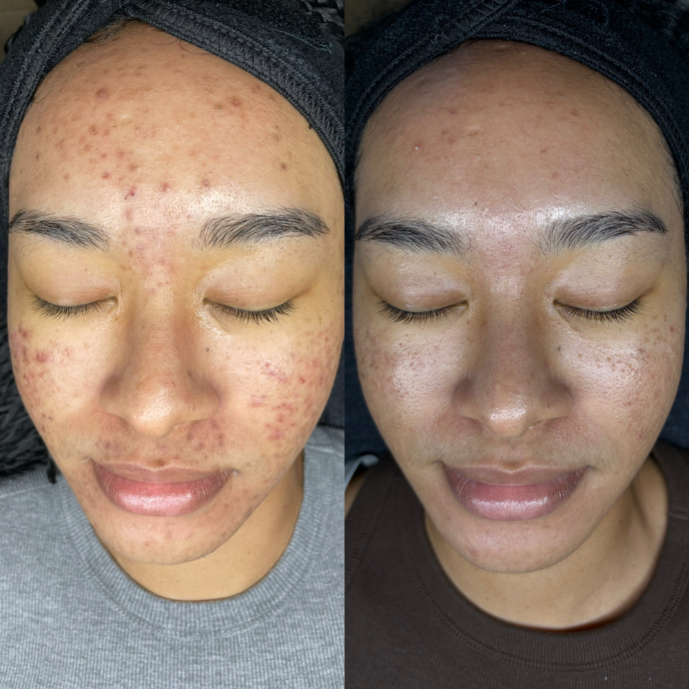 Liquid Microneedling