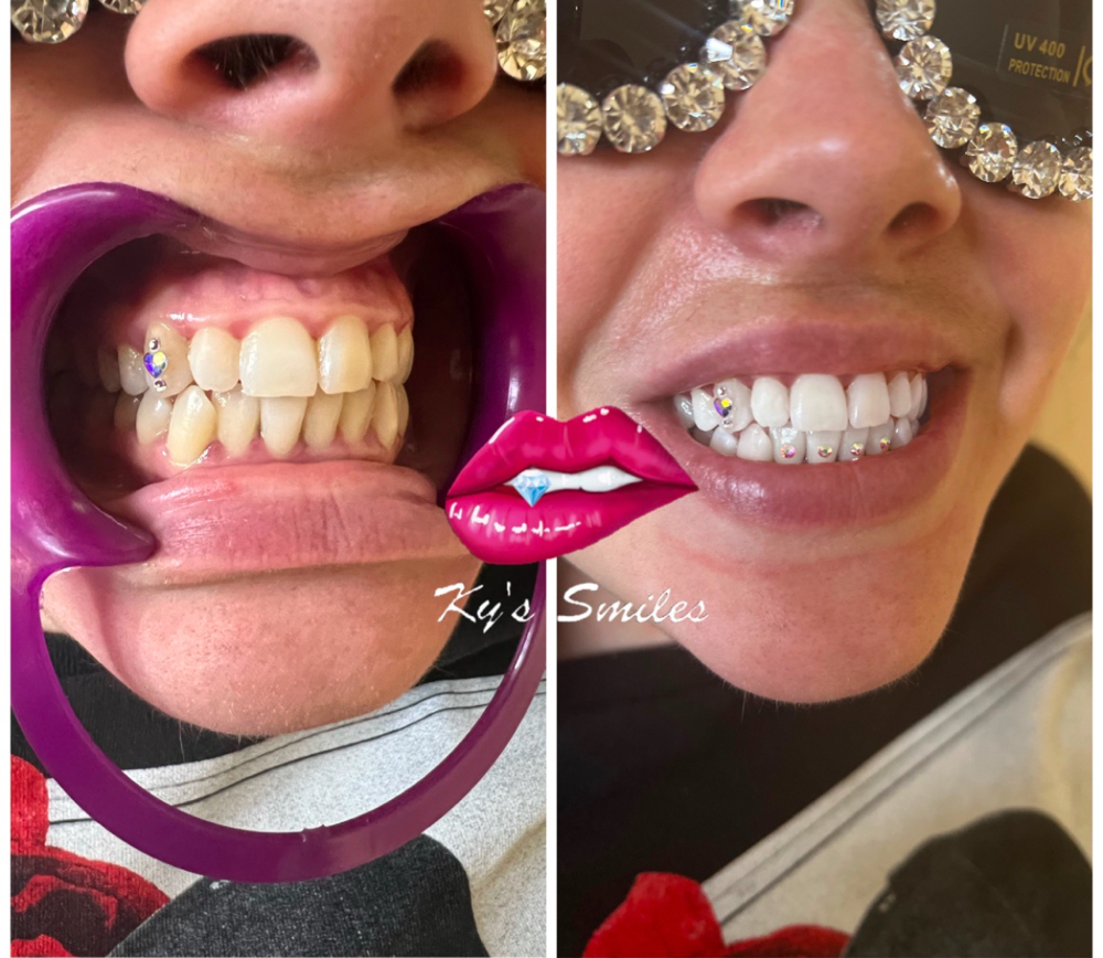 30 Minute Whitening Sesson