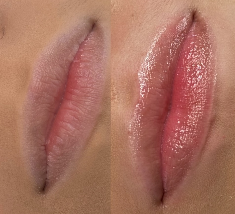 Hydralips
