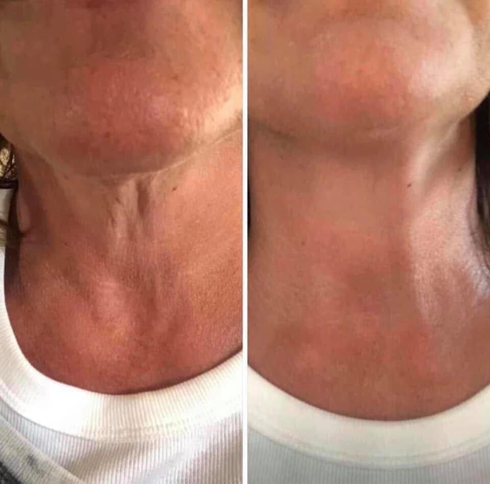 Facial Sculpting