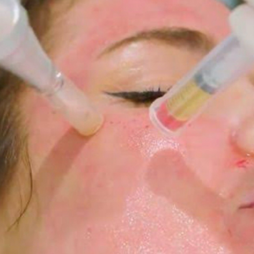 Vampire Facial With RF at Glow With Beauty LLC in Bristol, CT
