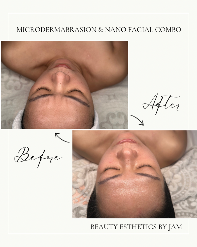 Infusion Facial w/Microdermabrasion