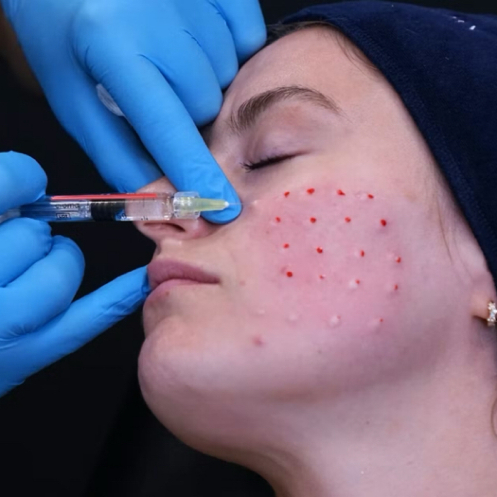 polynucleotides treatment at Injector Lucia in San Juan, TX