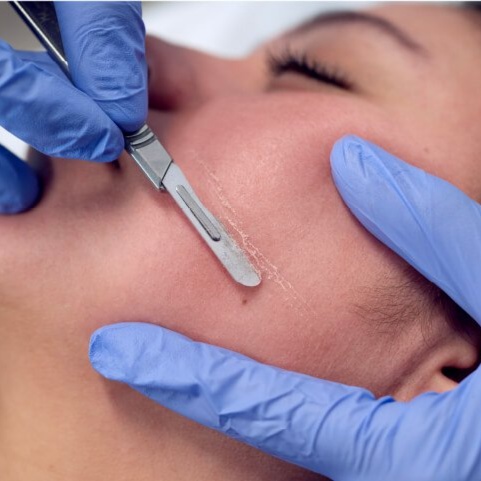 Dermaplaning at Lumeva Aesthetic  L.L.C in Maryland, MD