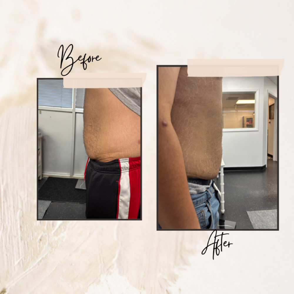 PCDC Upper Stomach Dissolve at Davis Wellness & Aesthetics in Cleburne, TX