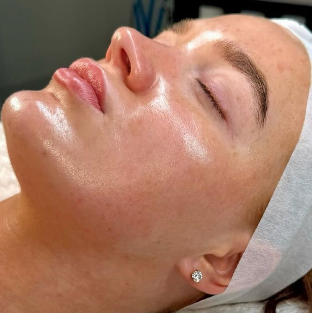 Mini Dermaplane Facial at Bare Skin Aesthetics in Amityville, NY