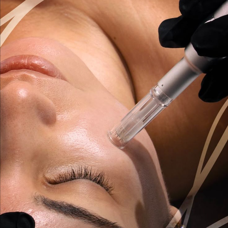 Micro needling with PRP at Beuxtique in Sugar Land, TX