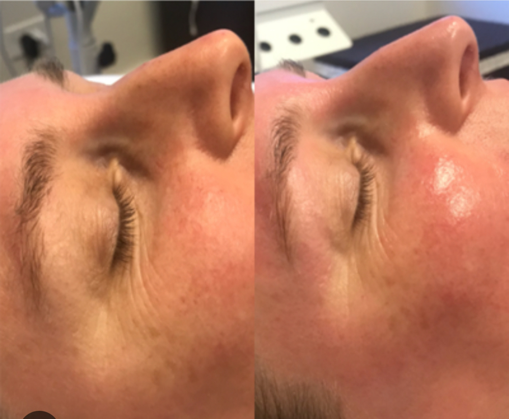 Dermaplane With Hydrojelly Mask