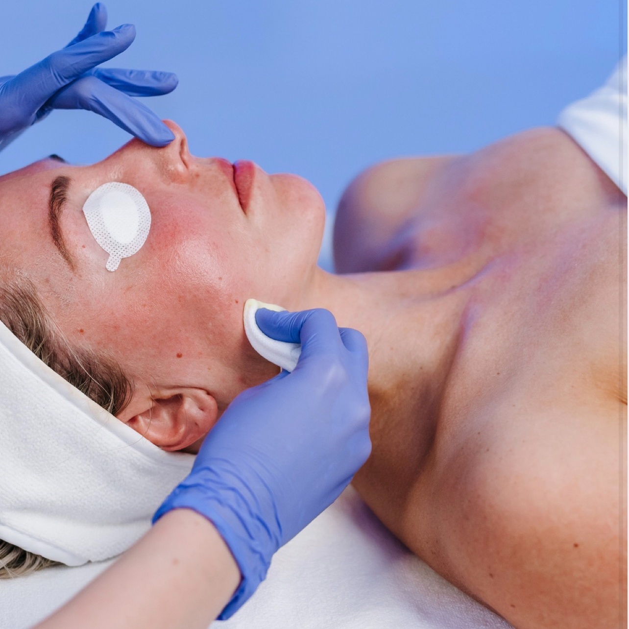 Custom Peel Treatment at CreedsSkincare in Prosper, TX
