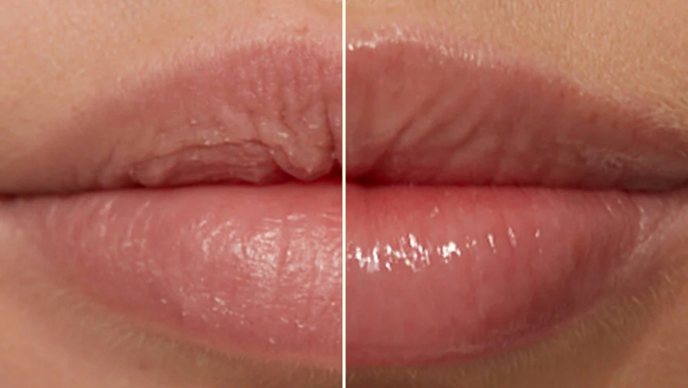 Lip Treatment (Add On Only)