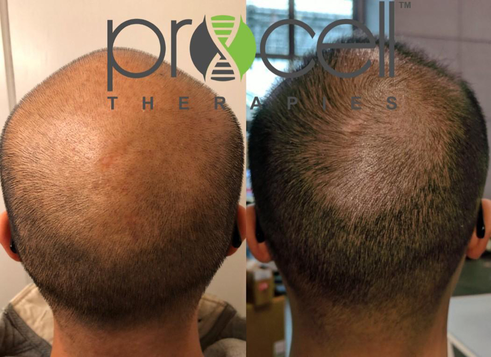 Hair Regrowth Treatment