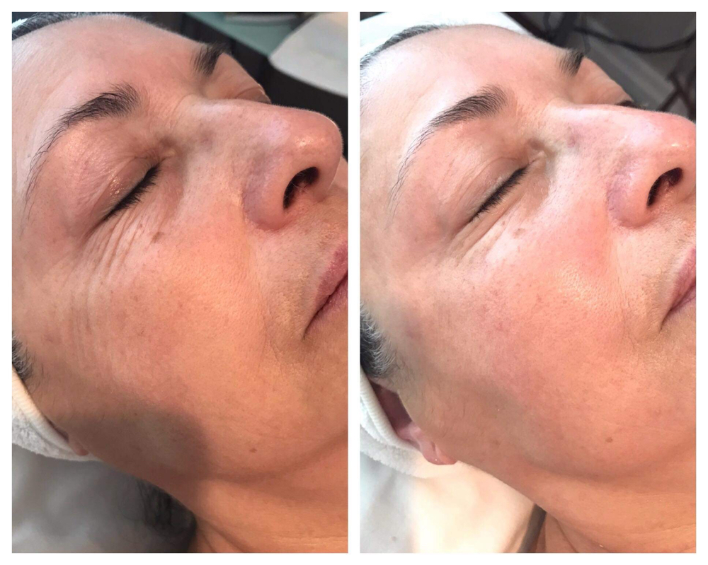 Nano Infusion Series Of 6