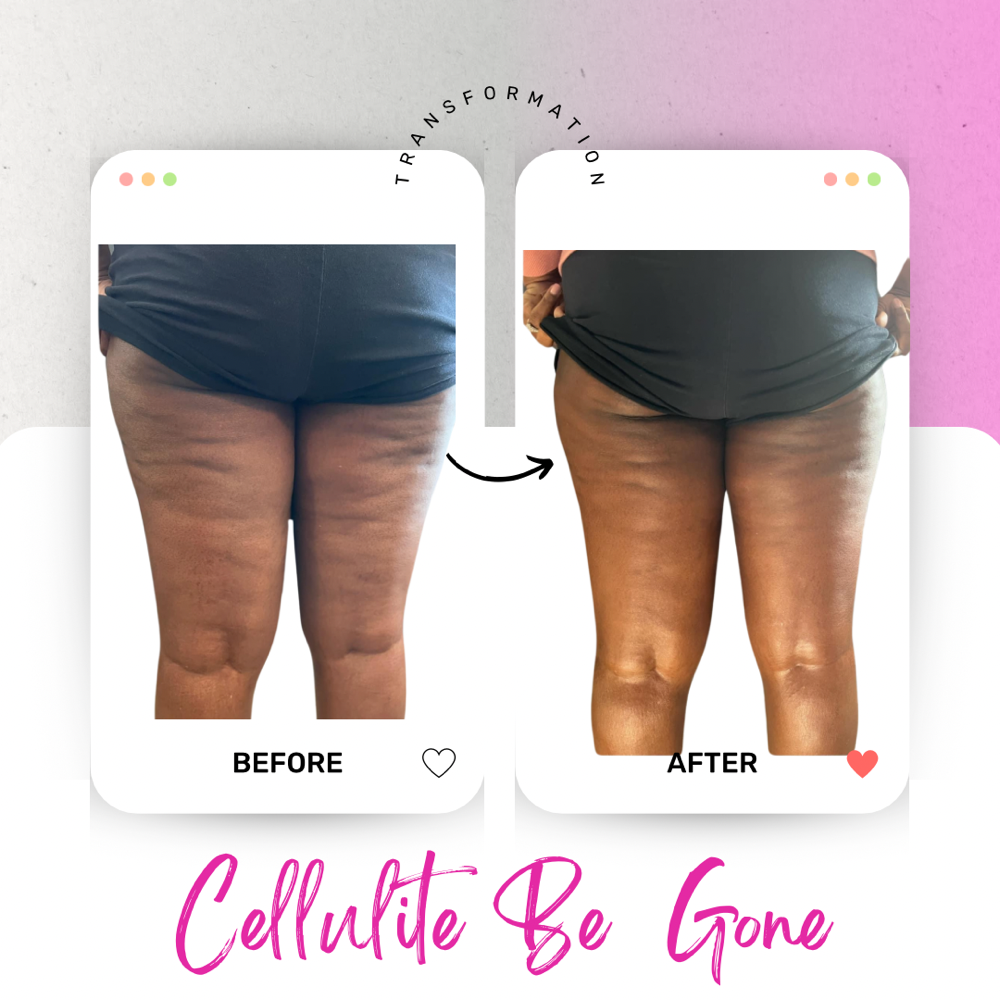 Cellulite be Gone