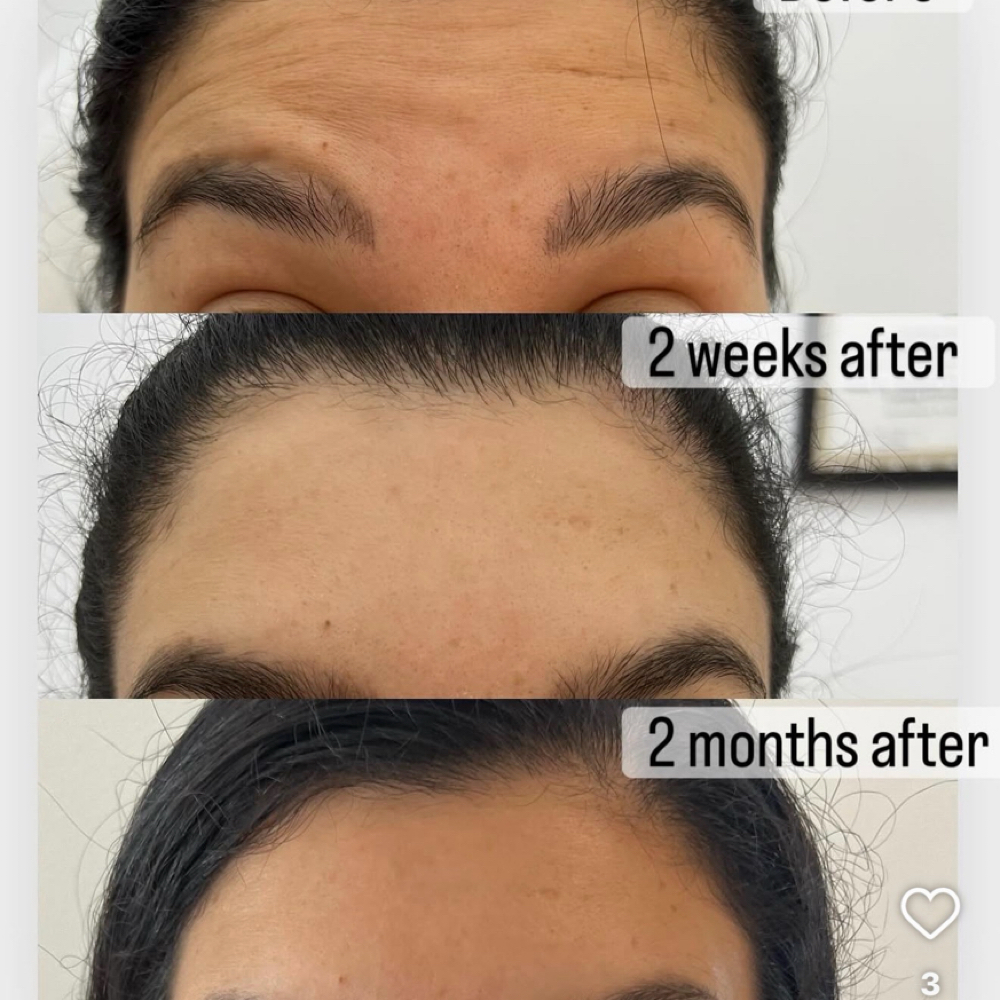 Botox at Ayona’s Medspa and Beauty Bar in Newnan, GA