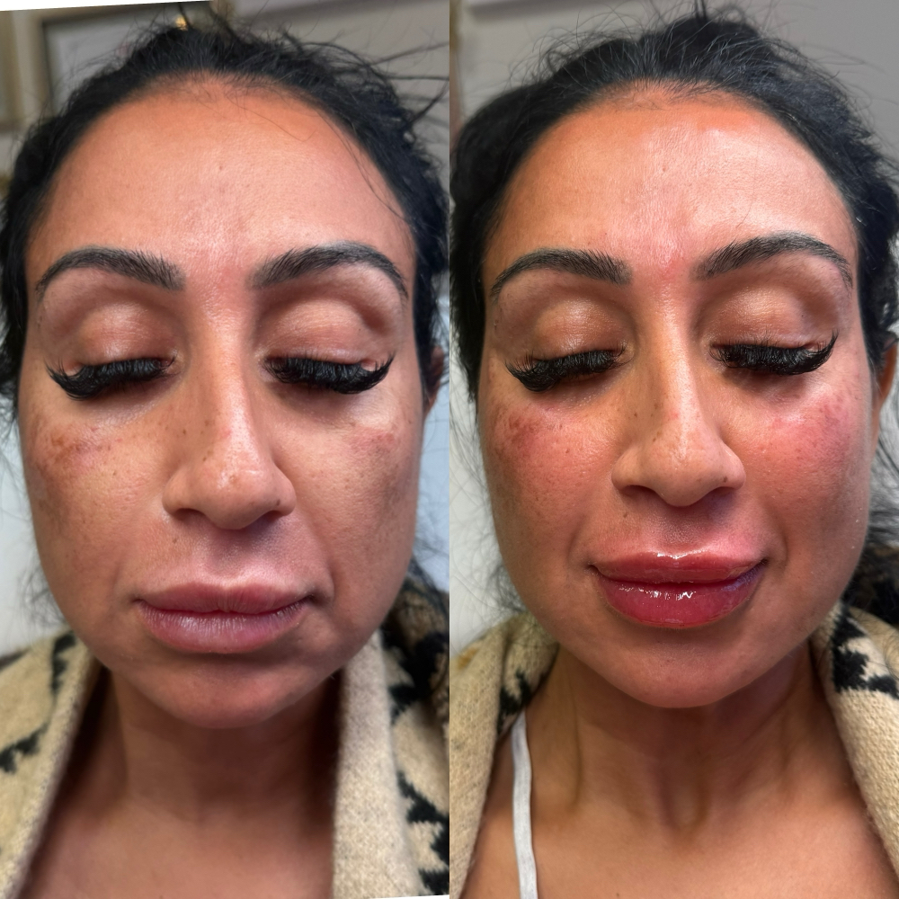 Cheek Filler ✨ at Bella Rose Aesthetics in San Antonio, TX