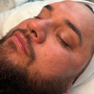 Radiant Renewal (Microdermabrasion) at Inclusive Esthetixs in CA, CA
