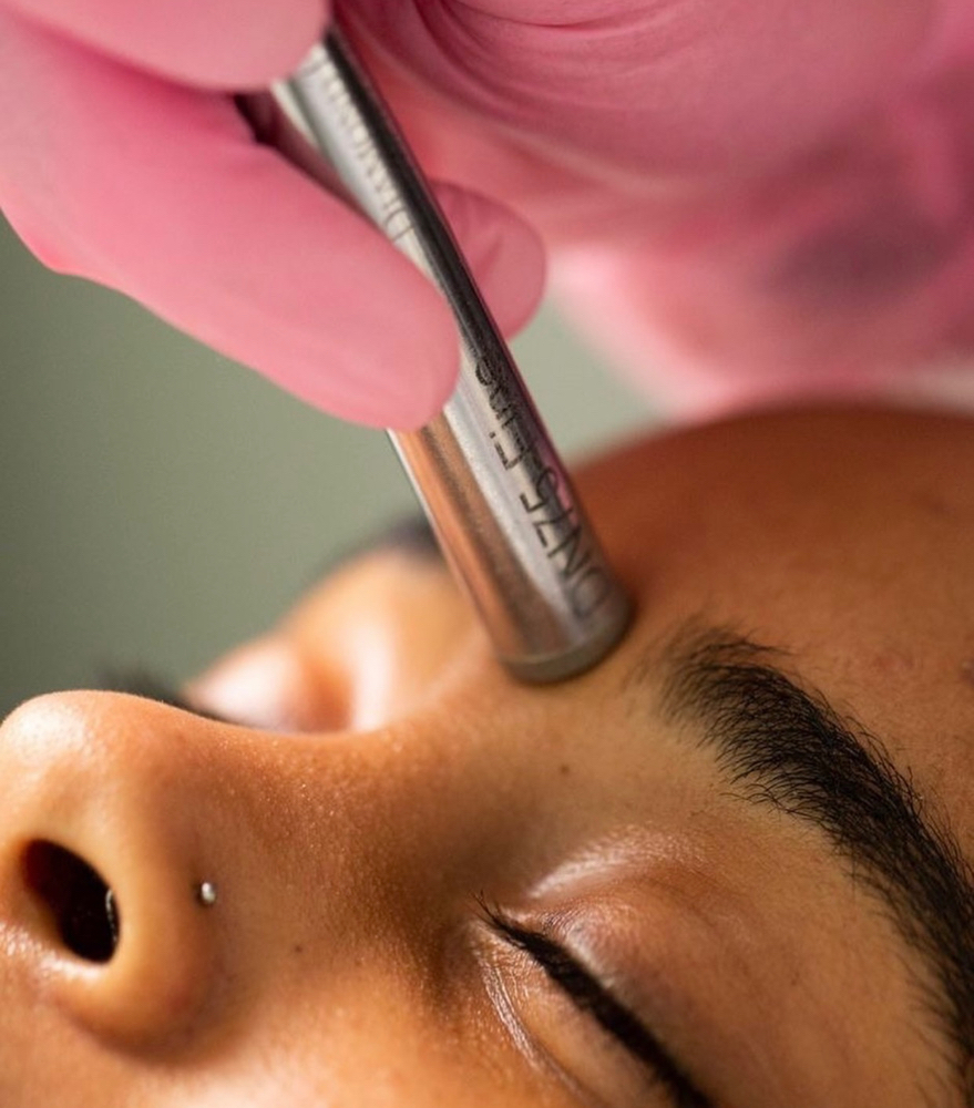 Micro-dermabrasion