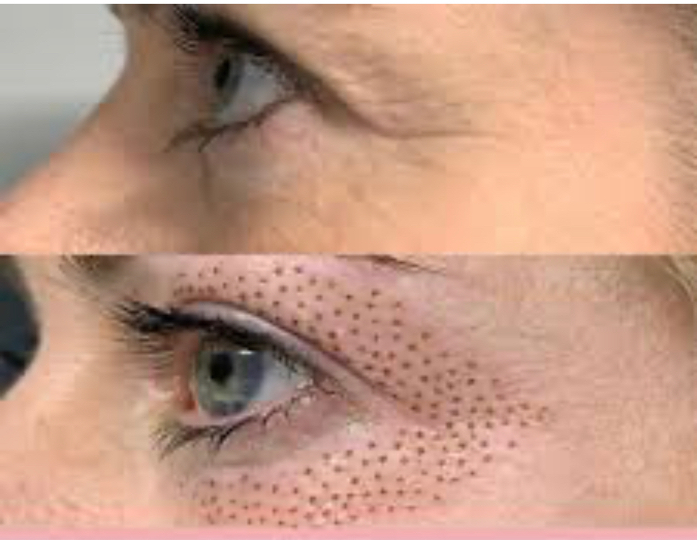 PLASMA FIBROBLAST TREATMENT