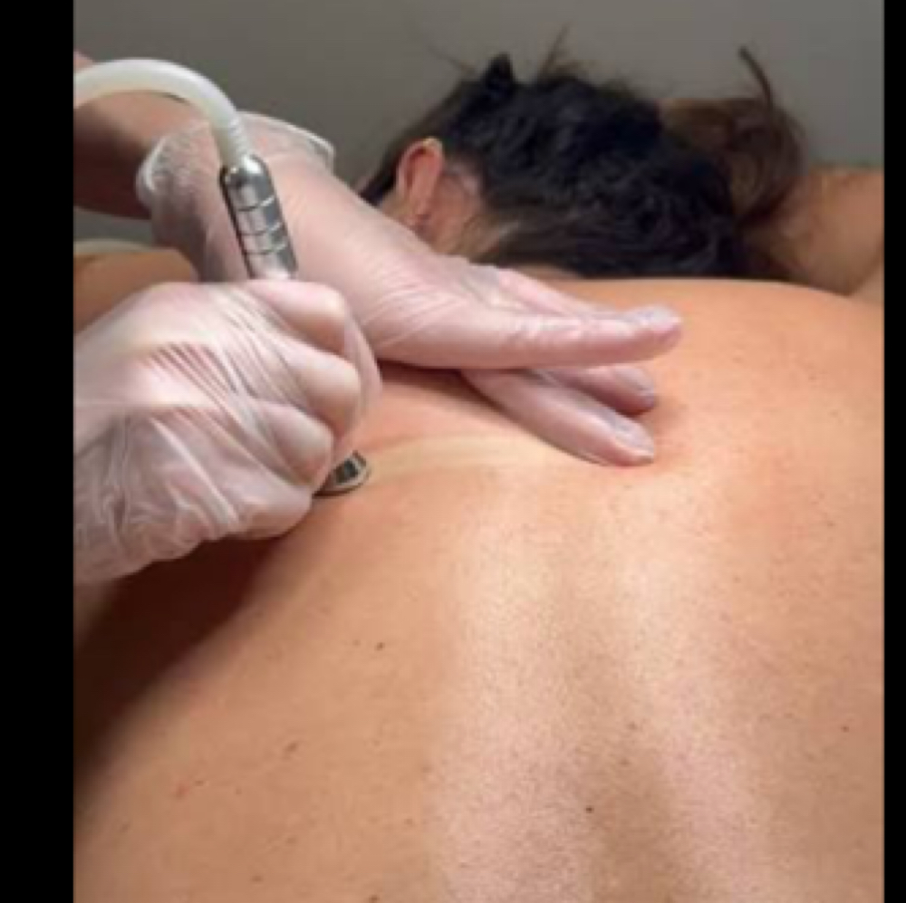 Back Microdermabrasion at Skinsational Beauty Boutique in Bethany, OK