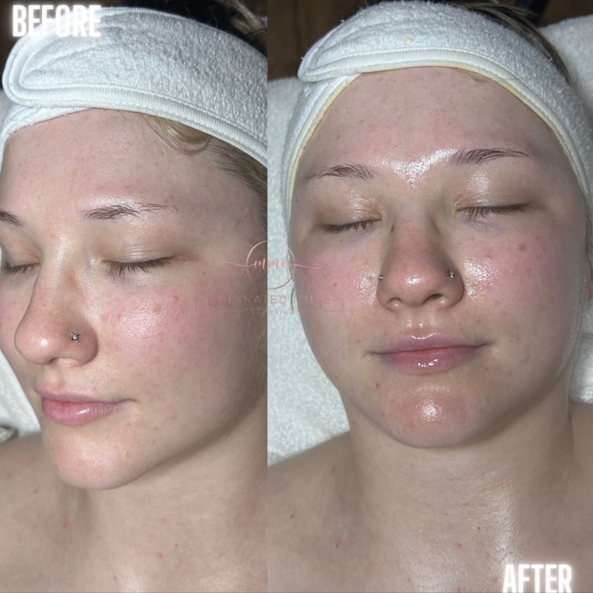 Calm Skin Facial at Melynated Muse Esthetics in Houston, TX