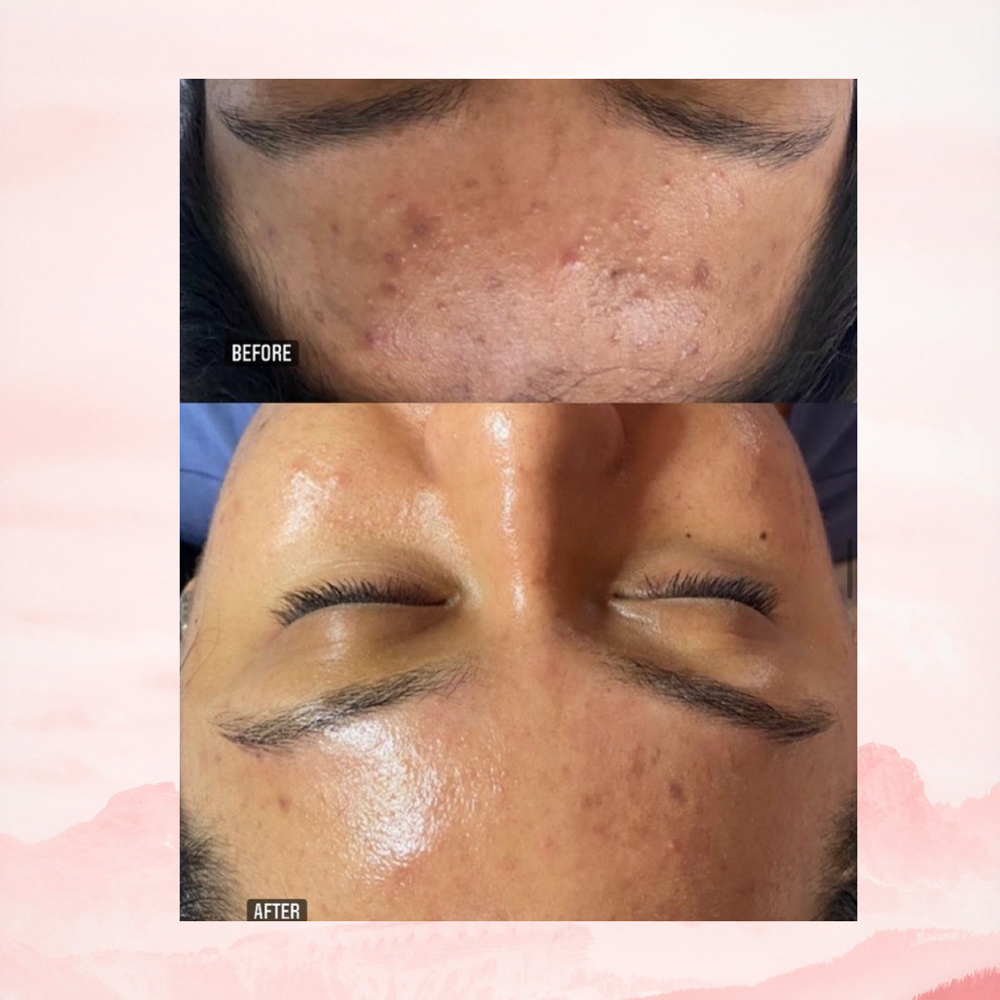 Enzyme Peel