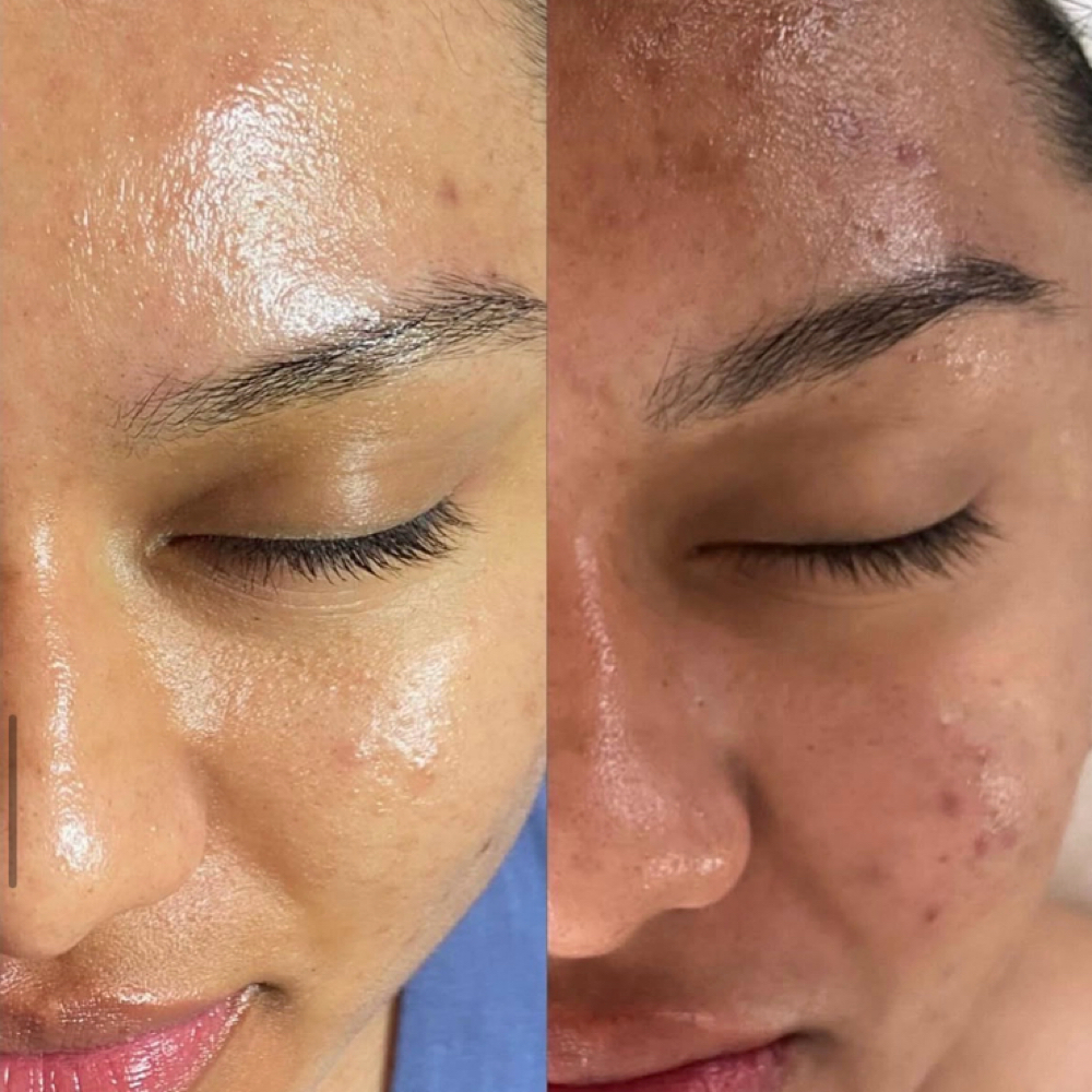 Enzyme Peel ( Beginners Peel) at Gleam Glitz Glow in Las Vegas, NV
