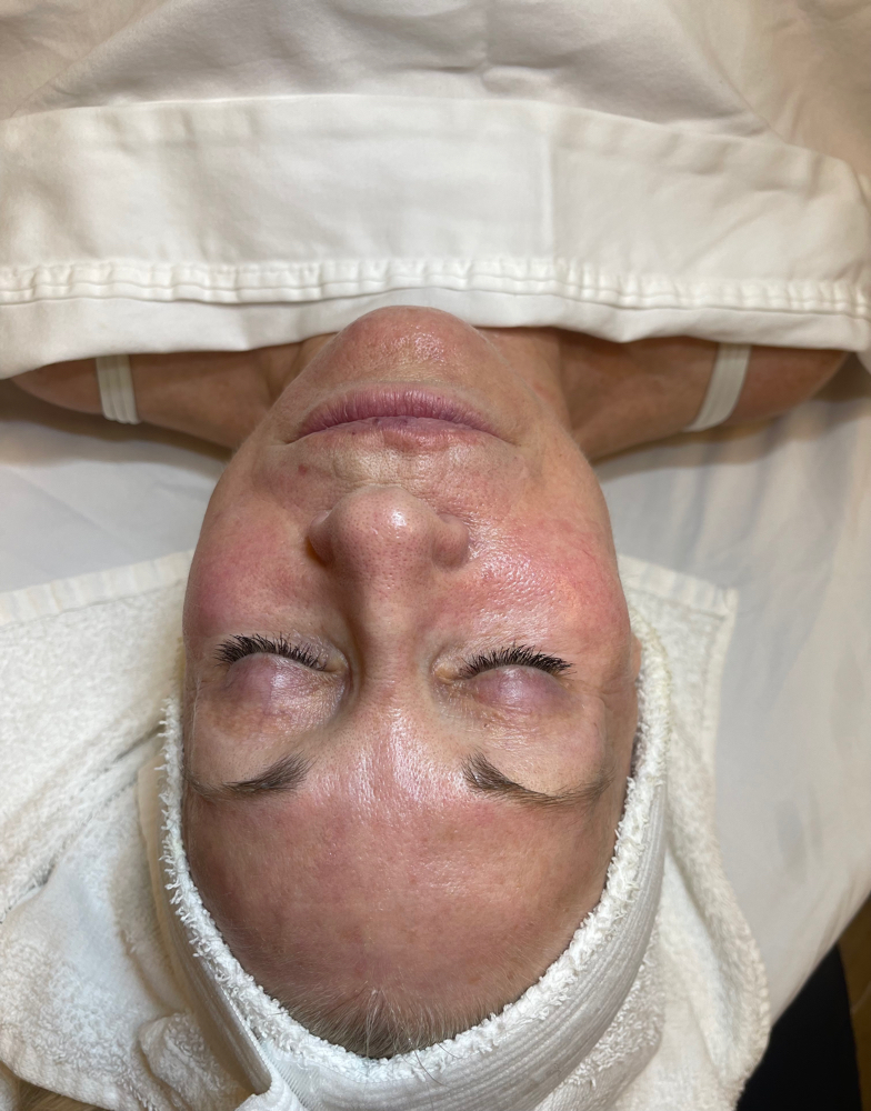 Chemical Peel