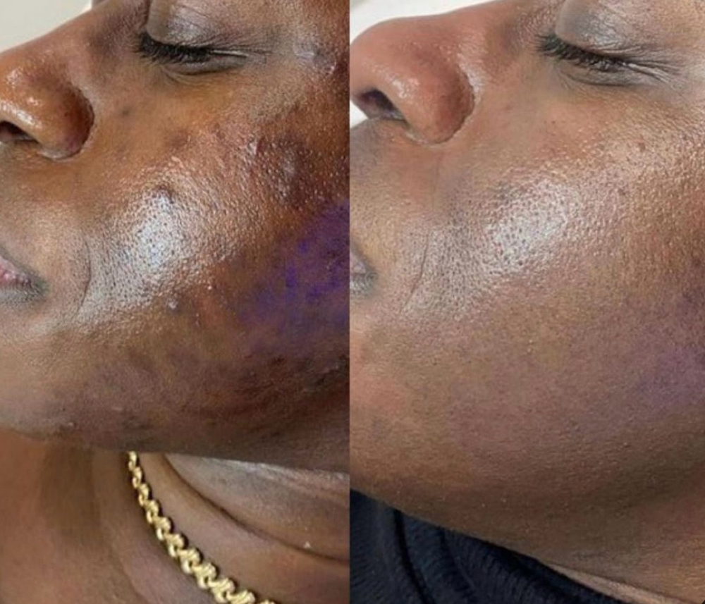 Chemical Peels: Tier Two at Chrome Skin and Beauty in Tamarac, FL