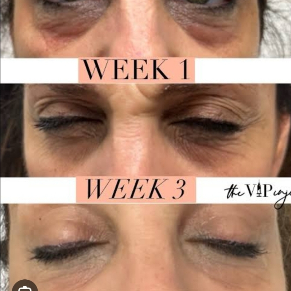 Toskani ECPR Under-Eye Treatment at Glass Face Aesthetics LLC in Fort Stockton, TX