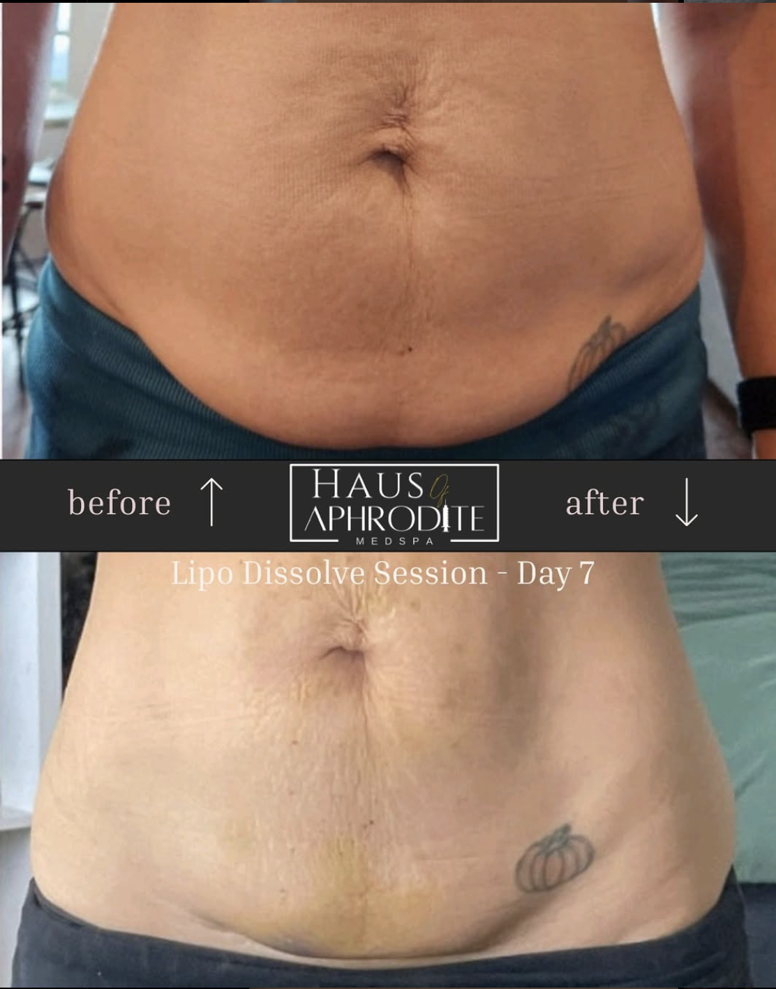 Stomach - Lipo Dissolve
