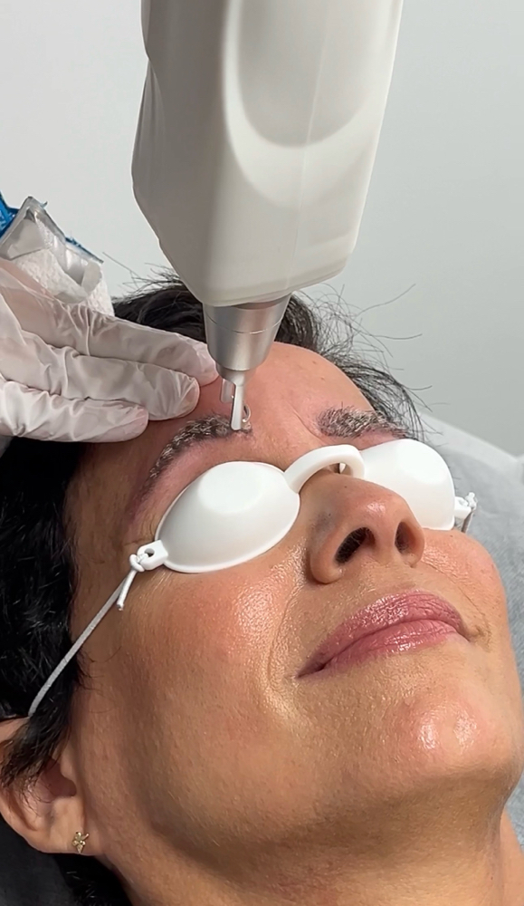 Laser Tattoo Removal