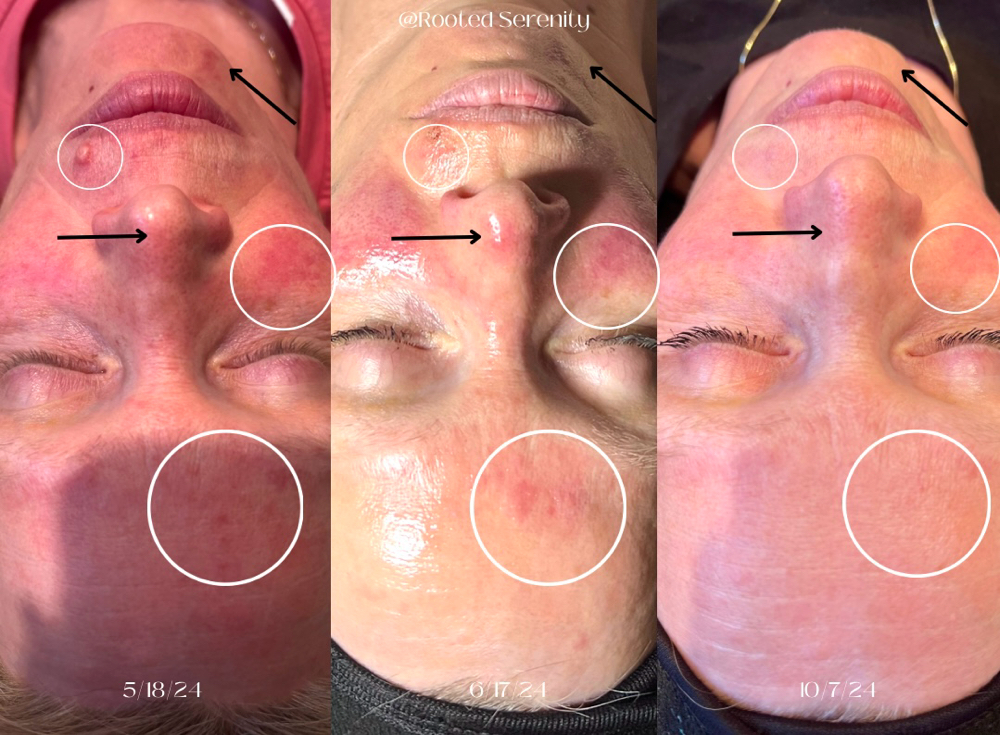 Custom Treatment Progression