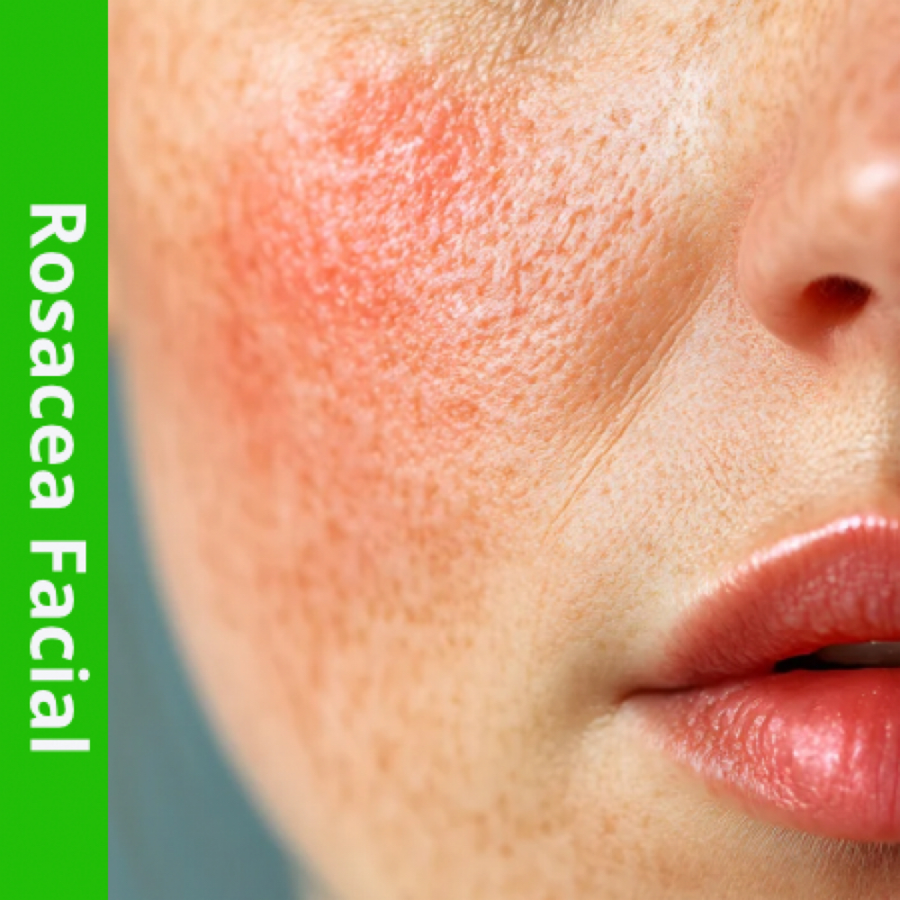 FollowUp Rosacea Treatment