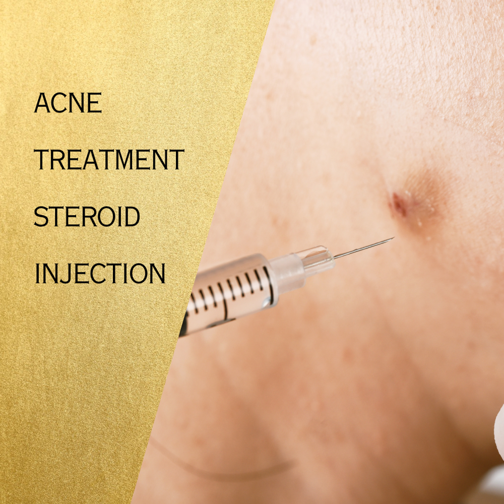 Acne Treatment With Steroid Inject