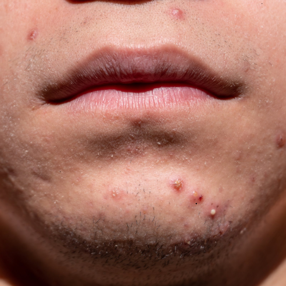 Acne Treatment With Steroid Inject at Rewind Med Spa in Longmont, CO